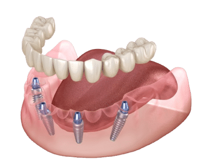 All-on-4 dental implants